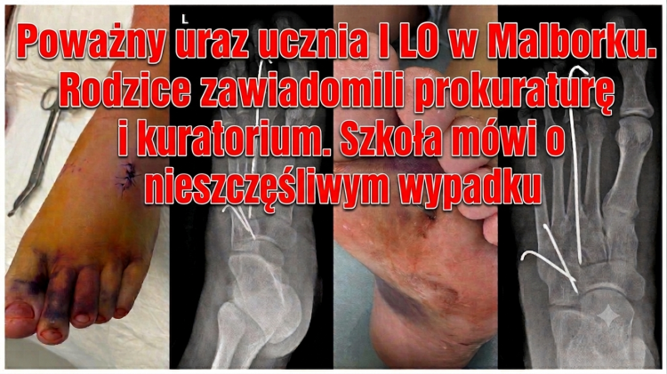 Poważny uraz ucznia I LO w Malborku. Rodzice zawiadomili prokuraturę i kuratorium. Szkoła mówi o nieszczęśliwym wypadku