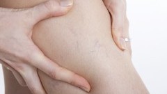 Metoda VNUS - przełom w leczeniu żylaków nóg
